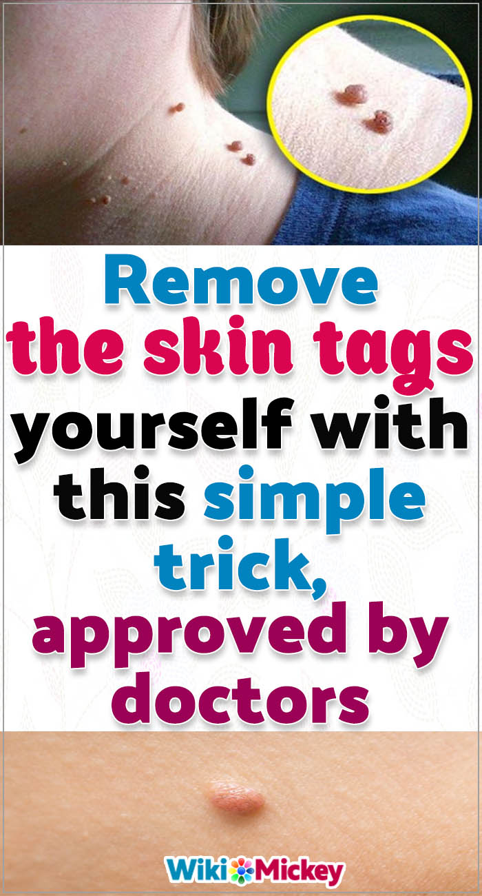 How To Remove Skin Tags Yourself With Duct Tape Howotre