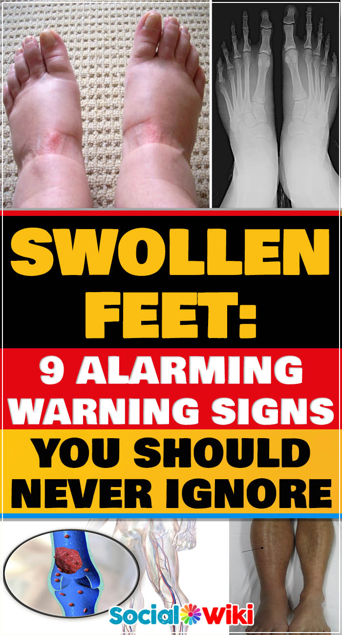 Swollen feet: 9 alarming warning signs you should never ignore 1
